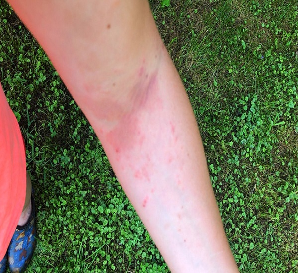 Prevent-poison-ivy-stings