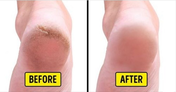 easy-home-remedies-to-get-rid-of-cracked-heels