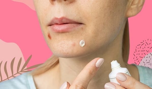 Using-Toothpaste-On-Pimples
