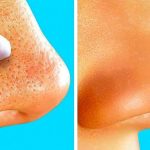 10-Simple-Solutions-to-Banish-Blackheads-at-Home